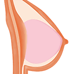 Gel breast